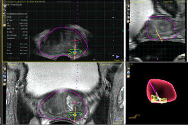 cancer mri