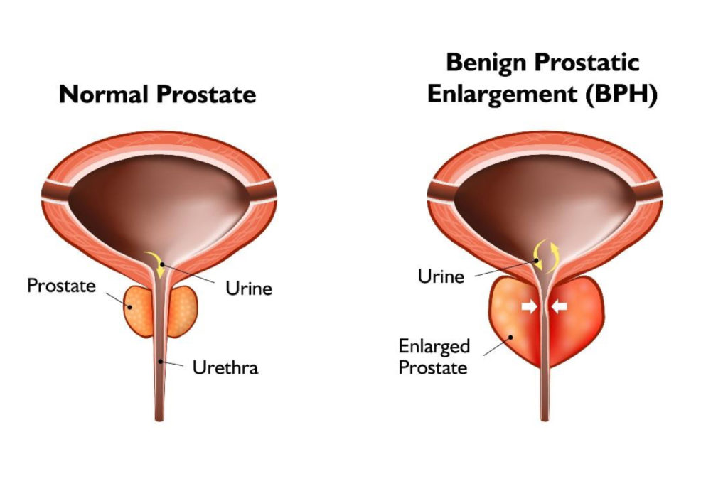 BPH Benign Prostatic Enlargement