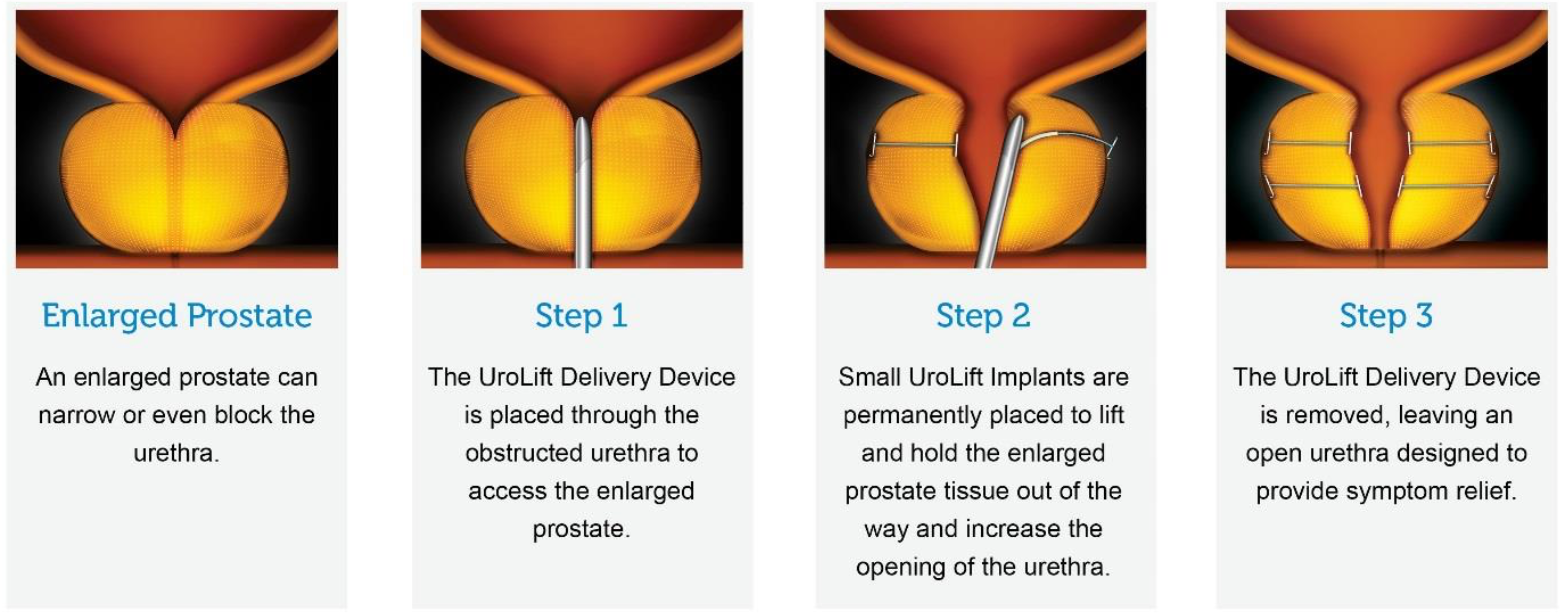 UroLift animation