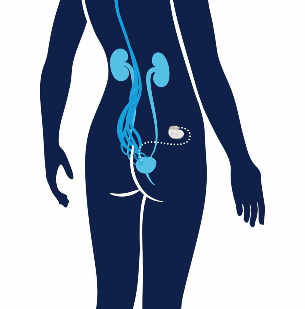 sacral neurostimulation