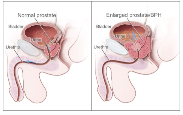 prostate-artery-embolization-st-louis